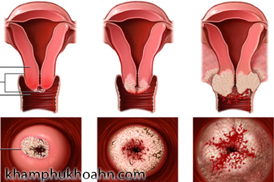 [Image: viem-co-tu-cung.jpg]