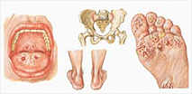 Chlamydia